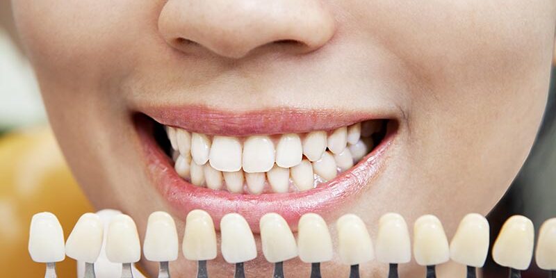 Alternative Methoden zur Zahnaufhellung – gibt es sie wirklich?